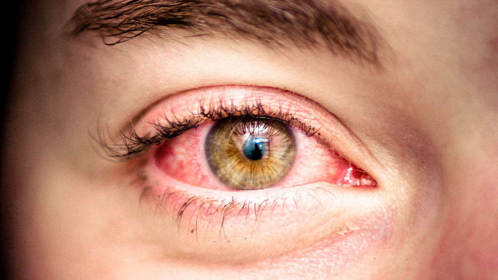Redness of eye Image source -- https://www.flickr.com/photos/hellyeahphotography/5317611080/sizes/l